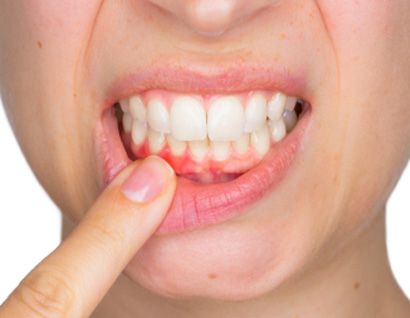 person pointing to bleeding gums